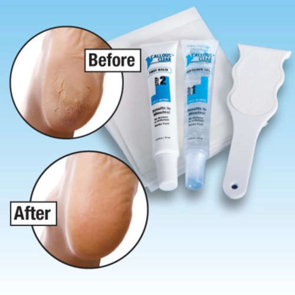 TVTimeDirect Health & Beauty Callous Clear Foot Treatment Kit Deluxe 4 TVTimeDirect Health & Beauty Callous Clear Foot Treatment Kit Deluxe