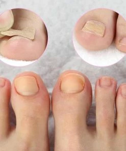 TVTimeDirect Health & Beauty Nail Correction Stickers For Ingrown Toenails (50 Count) 13 TVTimeDirect Health & Beauty Nail Correction Stickers For Ingrown Toenails (50 Count)